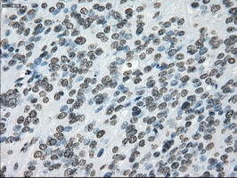 CYPOR / POR Antibody - IHC of paraffin-embedded Carcinoma of bladder tissue using anti-POR mouse monoclonal antibody. (Dilution 1:50).