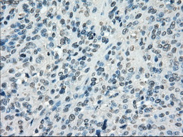CYPOR / POR Antibody - IHC of paraffin-embedded Carcinoma of bladder tissue using anti-POR mouse monoclonal antibody. (Dilution 1:50).