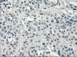 CYPOR / POR Antibody - IHC of paraffin-embedded Adenocarcinoma of breast tissue using anti-POR mouse monoclonal antibody. (Dilution 1:50).