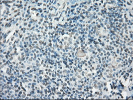 CYPOR / POR Antibody - IHC of paraffin-embedded Carcinoma of thyroid tissue using anti-POR mouse monoclonal antibody. (Dilution 1:50).