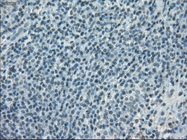 CYPOR / POR Antibody - IHC of paraffin-embedded lymphoma tissue using anti-POR mouse monoclonal antibody. (Dilution 1:50).