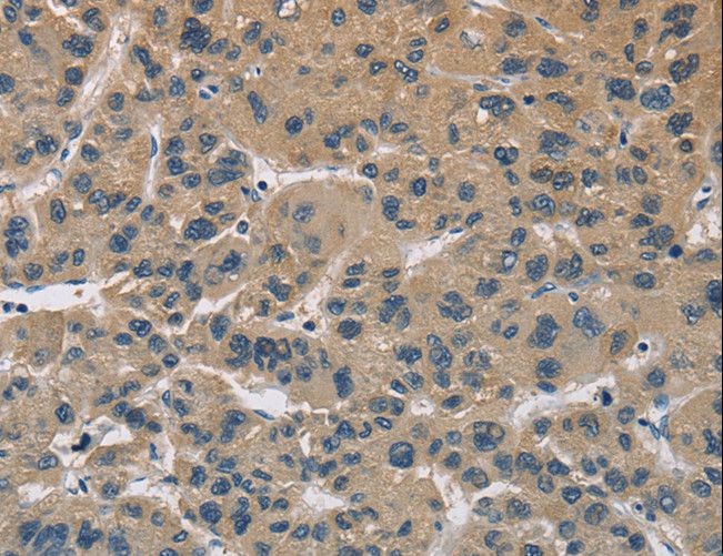 CYR61 Antibody - Immunohistochemistry of paraffin-embedded Human liver cancer using CYR61 Polyclonal Antibody at dilution of 1:60.