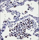 CYSLTR1 / CYSLT1 Antibody - CYSLTR1 Antibody immunohistochemistry of formalin-fixed and paraffin-embedded human lung tissue followed by peroxidase-conjugated secondary antibody and DAB staining.