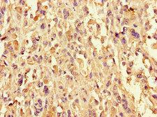 CYSLTR1 / CYSLT1 Antibody - Immunohistochemistry of paraffin-embedded human melanoma using CYSLTR1 Antibody at dilution of 1:100