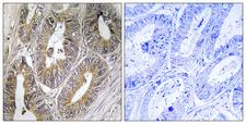 Cystatin SA / CST2 Antibody - Immunohistochemistry analysis of paraffin-embedded human colon carcinoma, using CST2 Antibody. The picture on the right is blocked with the synthesized peptide.
