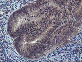 Cystatin SA / CST2 Antibody - IHC of paraffin-embedded Adenocarcinoma of Human endometrium tissue using anti-CST2 mouse monoclonal antibody.