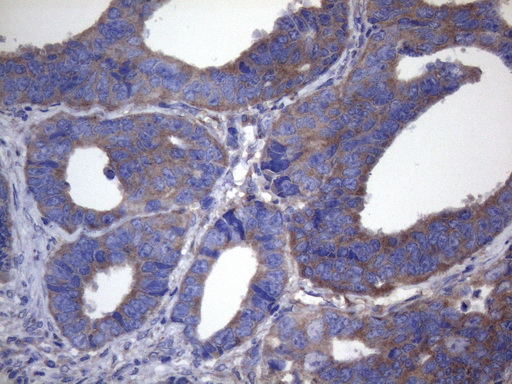 CYTH2 / Cytohesin 2 Antibody - Immunohistochemical staining of paraffin-embedded Adenocarcinoma of Human colon tissue using anti-CYTH2 mouse monoclonal antibody. (Heat-induced epitope retrieval by 1mM EDTA in 10mM Tris buffer. (pH8.5) at 120°C for 3 min. (1:150)