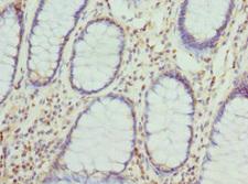 CYTH2 / Cytohesin 2 Antibody - Immunohistochemistry of paraffin-embedded human colon cancer at dilution 1:100