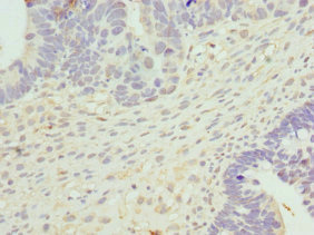 CYTH2 / Cytohesin 2 Antibody - Immunohistochemistry of paraffin-embedded human ovarian cancer at dilution 1:100