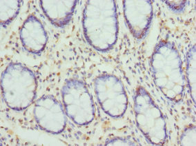 CYTH2 / Cytohesin 2 Antibody - Immunohistochemistry of paraffin-embedded human colon cancer at dilution 1:100