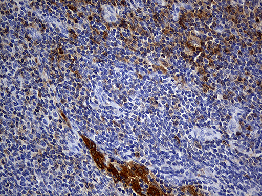 CYTH4 / PSCD4 Antibody - Immunohistochemical staining of paraffin-embedded Human lymphoma tissue using anti-CYTH4 mouse monoclonal antibody. (Heat-induced epitope retrieval by 1mM EDTA in 10mM Tris buffer. (pH8.5) at 120°C for 3 min. (1:150)