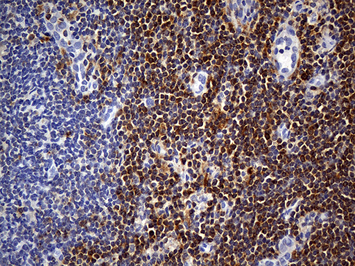 CYTH4 / PSCD4 Antibody - Immunohistochemical staining of paraffin-embedded Carcinoma of Human thyroid tissue using anti-CYTH4 mouse monoclonal antibody. (Heat-induced epitope retrieval by 1mM EDTA in 10mM Tris buffer. (pH8.5) at 120°C for 3 min. (1:150)