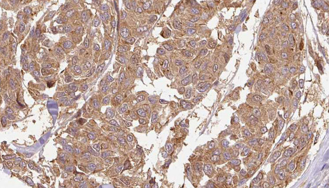 CYTL1 / C17 Antibody - 1:100 staining human Melanoma tissue by IHC-P. The sample was formaldehyde fixed and a heat mediated antigen retrieval step in citrate buffer was performed. The sample was then blocked and incubated with the antibody for 1.5 hours at 22°C. An HRP conjugated goat anti-rabbit antibody was used as the secondary.