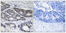 Cytochrome P450 2R1 / CYP2R1 Antibody - Immunohistochemistry analysis of paraffin-embedded human colon carcinoma, using Cytochrome P450 2R1 Antibody. The picture on the right is blocked with the synthesized peptide.