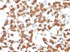 Cytokeratin 1+8 Antibody - Formalin-fixed, paraffin-embedded human thyroid carcinoma stained with Keratin 18 antibody (C-04).  This image was taken for the unmodified form of this product. Other forms have not been tested.