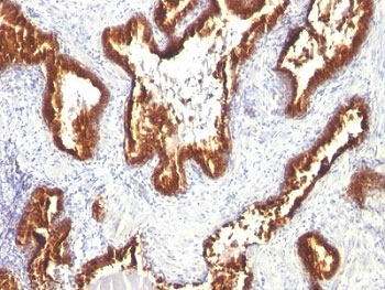 Cytokeratin 1+8 Antibody - Formalin-fixed, paraffin-embedded human prostate carcinoma stained with Keratin 18 antibody (KRT18/1190).  This image was taken for the unmodified form of this product. Other forms have not been tested.