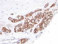Cytokeratin 1+8 Antibody - Formalin-fixed, paraffin-embedded human breast carcinoma stained with anti-Cytokeratin 18 antibody (SPM510).  This image was taken for the unmodified form of this product. Other forms have not been tested.