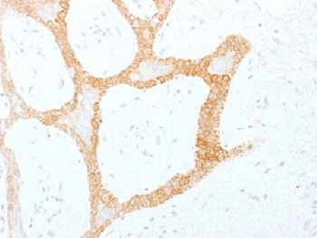 Cytokeratin 5+8 Antibody - IHC analysis of formalin-fixed, paraffin-embedded human colon carcinoma stained with Cytokeratin 5 + 8 antibody (clone C-50). Required HIER: digest sections with Trypsin at 1mg/ml, 15 min, at RT.