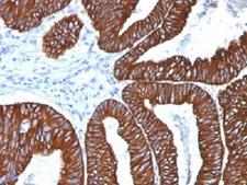 Cytokeratin 8+18 Antibody - IHC analysis of FFPE human colon carcinoma with Cytokeratin 8/18 antibody (clone 5D3). Required HIER: boil tissue sections in 10mM citrate buffer, pH 6, for 10-20 min.