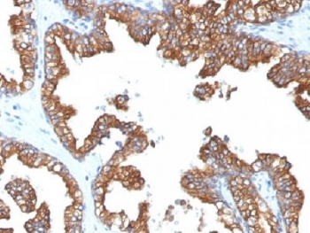 Cytokeratin 8+18 Antibody - IHC analysis of FFPE human prostate carcinoma with Cytokeratin 8/18 antibody (clone 5D3). Required HIER: boil tissue sections in 10mM citrate buffer, pH 6, for 10-20 min.