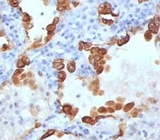 Cytokeratin 8+18 Antibody - Formalin-fixed, paraffin-embedded human lung carcinoma stained with Cytokeratin 8 + 18 antibody (B22.1 + B23.1).  This image was taken for the unmodified form of this product. Other forms have not been tested.