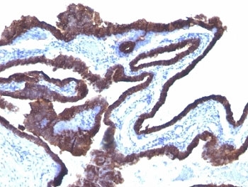 Cytokeratin 8+18 Antibody - Formalin-fixed, paraffin-embedded human ovarian cancer stained with Cytokeratin 8 + 18 antibody (C-43 + DC10).  This image was taken for the unmodified form of this product. Other forms have not been tested.