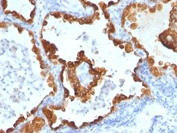 Cytokeratin 8+18 Antibody - Formalin-fixed, paraffin-embedded human lung carcinoma stained with Cytokeratin 8 + 18 antibody (C-43 + DC10).  This image was taken for the unmodified form of this product. Other forms have not been tested.