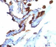 Cytokeratin 8+18 Antibody - Formalin-fixed, paraffin-embedded human lung carcinoma stained with Cytokeratin 8 + 18 antibody (C-51).  This image was taken for the unmodified form of this product. Other forms have not been tested.