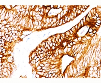 Cytokeratin 8+18 Antibody - Cytokeratin 8 + 18 antibody K8.8 + DC10 immunohistochemistry colon carcinoma.  This image was taken for the unmodified form of this product. Other forms have not been tested.