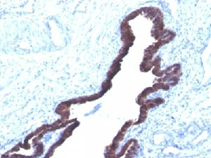 Cytokeratin 8+18 Antibody - IHC staining of FFPE human ovarian cancer with Cytokeratin 8 + 18 antibody (K8.8 + DC10).