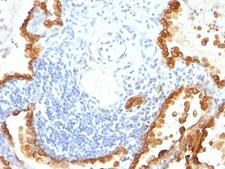 Cytokeratin 8+18 Antibody - Formalin-fixed, paraffin-embedded human lung carcinoma stained with Cytokeratin 8 + 18 antibody (KRT8/803 + KRT18/835).  This image was taken for the unmodified form of this product. Other forms have not been tested.