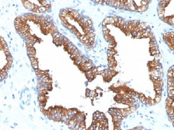 Cytokeratin 8+18 Antibody - IHC analysis of FFPE human prostate carcinoma with Cytokeratin 8/18 antibody (clone KRT8.18/1346). Required HIER: boil tissue sections in 10mM citrate buffer, pH 6, for 10-20 min.