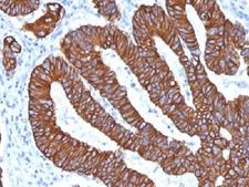 Cytokeratin 8+18 Antibody - IHC analysis of FFPE human colon carcinoma with Cytokeratin 8/18 antibody (clone KRT8.18/1346). Required HIER: boil tissue sections in 10mM citrate buffer, pH 6, for 10-20 min.