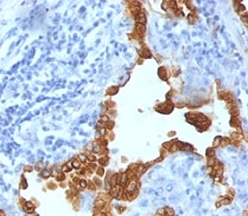 Cytokeratin 8+18 Antibody - Formalin-fixed, paraffin-embedded human lung carcinoma stained with Cytokeratin 8 + 18 antibody (SPM141).  This image was taken for the unmodified form of this product. Other forms have not been tested.