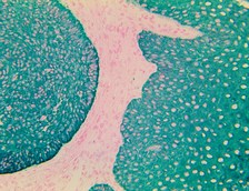 Cytokeratin AE1+AE3 Antibody - IHC of Cytokeratin AE1/AE3 on a Frozen NBF 10%-Fixed Basal Cell Carcinoma Tissue
