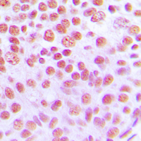 Cytokine IK Antibody - Immunohistochemical analysis of Cytokine IK staining in human breast cancer formalin fixed paraffin embedded tissue section. The section was pre-treated using heat mediated antigen retrieval with sodium citrate buffer (pH 6.0). The section was then incubated with the antibody at room temperature and detected using an HRP conjugated compact polymer system. DAB was used as the chromogen. The section was then counterstained with hematoxylin and mounted with DPX.