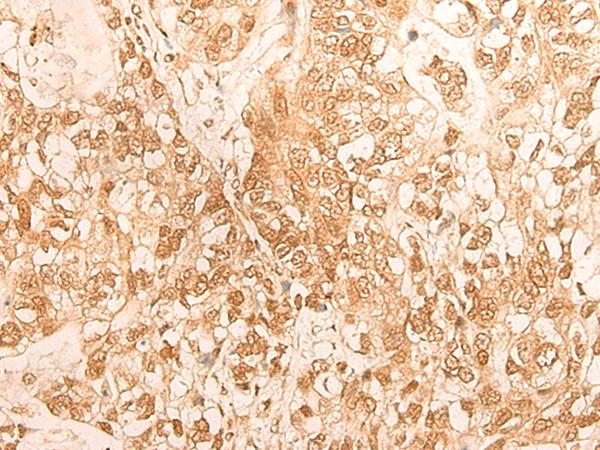 D-Binding Protein / DBP Antibody - Immunohistochemistry of paraffin-embedded Human gastric cancer tissue  using DBP Polyclonal Antibody at dilution of 1:25(×200)
