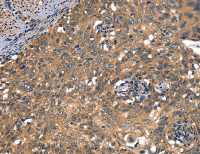 DAAM1 Antibody - Immunohistochemistry of paraffin-embedded Human cervical cancer using DAAM1 Polyclonal Antibody at dilution of 1:50.