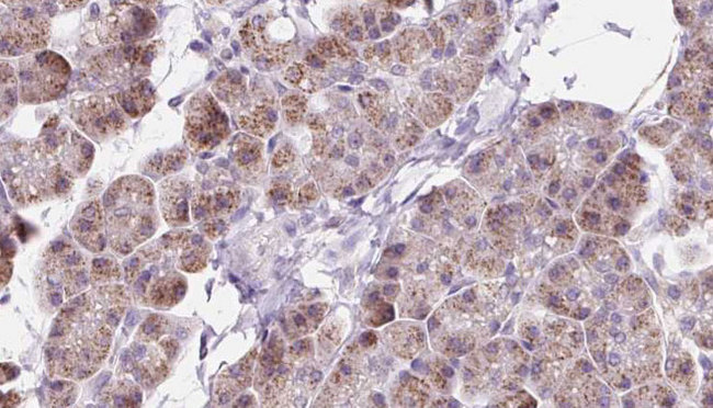 DAAM1 Antibody - 1:100 staining human pancreas carcinoma tissue by IHC-P. The sample was formaldehyde fixed and a heat mediated antigen retrieval step in citrate buffer was performed. The sample was then blocked and incubated with the antibody for 1.5 hours at 22°C. An HRP conjugated goat anti-rabbit antibody was used as the secondary.