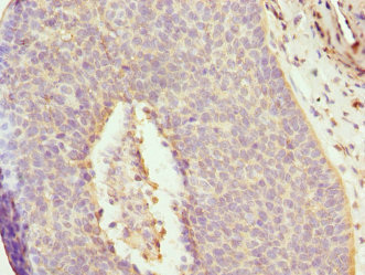 DAAM2 Antibody - Immunohistochemistry of paraffin-embedded human cervical cancer at dilution 1:100