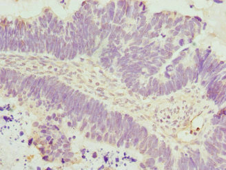 DAAM2 Antibody - Immunohistochemistry of paraffin-embedded human ovarian cancer at dilution 1:100
