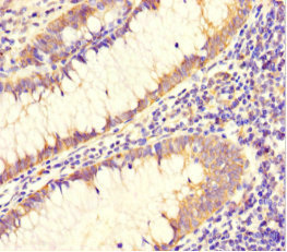 DAAM2 Antibody - Immunohistochemistry of paraffin-embedded human colon cancer at dilution 1:100
