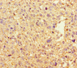 DAAM2 Antibody - Immunohistochemistry of paraffin-embedded human melanoma cancer at dilution 1:100
