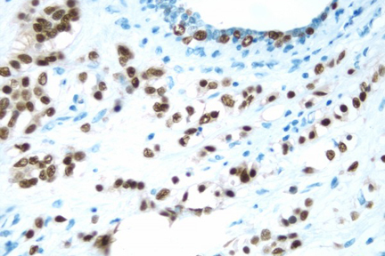 Product - Breast: Estrogen Receptor (m), ImmPRESS™ Anti-Mouse Ig Kit, DAB Substrate Kit (brown). Hematoxylin counterstain (blue).