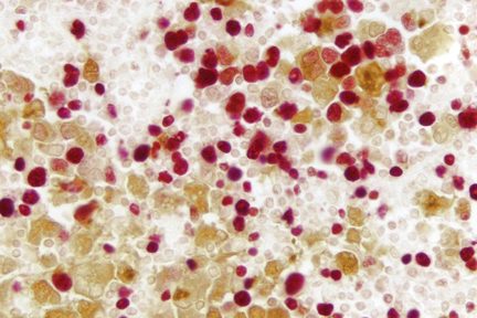Product - Lymph Node (double label): Ki67 (m), VECTASTAIN® Universal ABC-AP Kit, Vector Red™ Substrate (red); Multi-cytokeratin (m), VECTASTAIN® Universal Elite® ABC Kit, DAB substrate (brown).