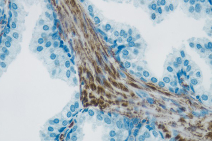 Product - Tumor tissue section showing specific cytoplasmic cell staining (brown, Vector® DAB) with Vector® Hematoxylin QS (blue) counterstain.