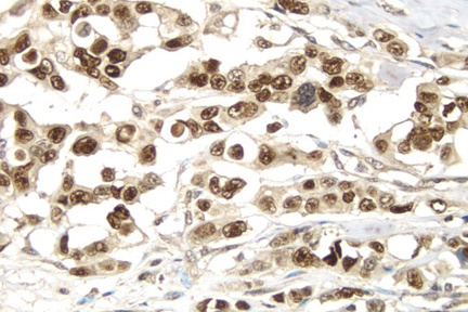 Product - Breast Cancer: p53 protein stained using VECTASTAIN® Elite® ABC Kit and Vector® DAB (brown) substrate. Hematoxylin QS (blue) counterstain.