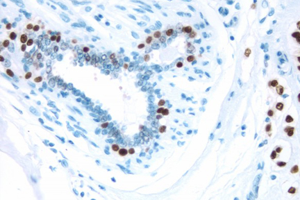 Product - Breast Cancer: Estrogen receptor stained using VECTASTAIN® Elite® ABC Kit and Vector® DAB (brown) substrate. Hematoxylin QS (blue) counterstain.