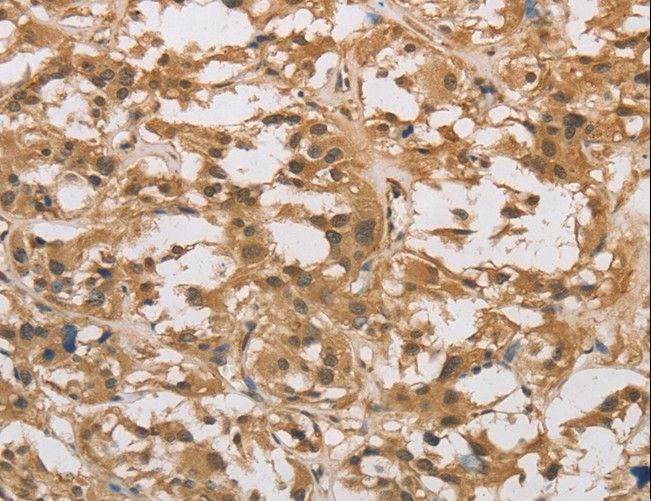 DAB2 Antibody - Immunohistochemistry of paraffin-embedded Human thyroid cancer using DAB2 Polyclonal Antibody at dilution of 1:30.