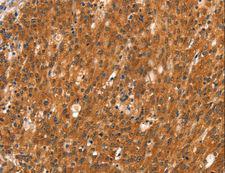 DAB2IP Antibody - Immunohistochemistry of paraffin-embedded Human thyroid cancer using DAB2IP Polyclonal Antibody at dilution of 1:40.